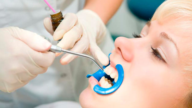 Lady having Dental sealants Treatment